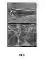 Fig. 04 - Method for synthesizing carbon nanowires on surface of pores or gaps in structure