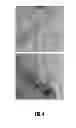 Fig. 05 - Method for synthesizing carbon nanowires on surface of pores or gaps in structure