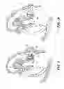 Fig. 09 - Implantable microphone for hearing systems