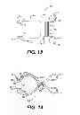 Fig. 07 - Transventricular implant tools and devices