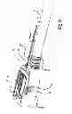 Fig. 04 - ENDOSCOPIC FULL THICKNESS RESECTION USING SURGICAL COMPRESSION CLIPS