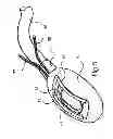 Fig. 07 - ENDOSCOPIC FULL THICKNESS RESECTION USING SURGICAL COMPRESSION CLIPS