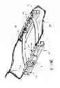 Fig. 09 - ENDOSCOPIC FULL THICKNESS RESECTION USING SURGICAL COMPRESSION CLIPS
