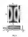 Fig. 06 - System and method for imaging of the vascular components with temporal information and suppressed blood pools using magnetic resonance imaging