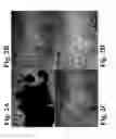 Fig. 03 - BUBBLE-INDUCED COLOR DOPPLER FEEDBACK DURING HISTOTRIPSY
