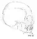 Fig. 04 - Speech therapy device