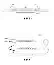 Fig. 11 - Methods and apparatus for anchoring within the gastrointestinal tract