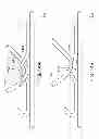 Fig. 15 - Methods and apparatus for anchoring within the gastrointestinal tract