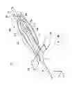 Fig. 18 - Indwelling needle device