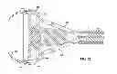 Fig. 14 - ATTACHABLE UTERINE DEVICE WITH INTEGRATED AND TIME RELEASE MEDICINAL ADMINISTERING COMPONENT AND INSERTION TOOL FOR IMPLANTING SUCH A DEVICE