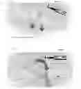 Fig. 04 - Catheter vacuum dressing apparatus and methods of use