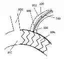 Fig. 01 - Fenestration through foreign material