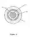 Fig. 03 - Fenestration through foreign material