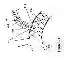 Fig. 13 - Fenestration through foreign material