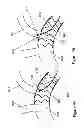 Fig. 14 - Fenestration through foreign material