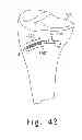 Fig. 29 - Method for cutting bone during an orthopaedic surgical procedure