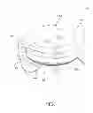 Fig. 02 - Prosthesis guide comprising patient-matched features