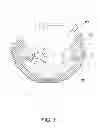 Fig. 08 - Prosthesis guide comprising patient-matched features