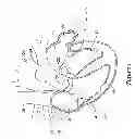 Fig. 02 - CENTERED BALLOON FOR THE LEFT ATRIAL APPENDAGE