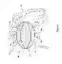Fig. 08 - CENTERED BALLOON FOR THE LEFT ATRIAL APPENDAGE