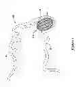 Fig. 09 - CENTERED BALLOON FOR THE LEFT ATRIAL APPENDAGE