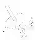 Fig. 21 - CENTERED BALLOON FOR THE LEFT ATRIAL APPENDAGE