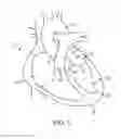 Fig. 02 - System and method for transapical access and closure