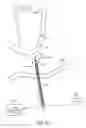 Fig. 32 - System and method for transapical access and closure