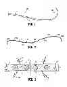 Fig. 02 - Method of closure for thoracotomy and thorascopy incisions