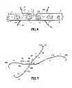 Fig. 04 - Method of closure for thoracotomy and thorascopy incisions
