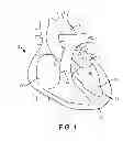 Fig. 02 - System and method for transapical access and closure