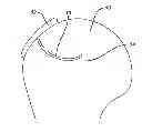 Fig. 01 - Directionally specific bone anchors and method