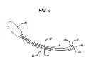 Fig. 06 - Directionally specific bone anchors and method