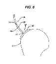 Fig. 07 - Directionally specific bone anchors and method