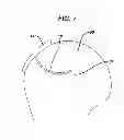 Fig. 08 - Directionally specific bone anchors and method