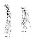 Fig. 03 - SYSTEM AND METHOD FOR ALIGNING VERTEBRAE IN THE AMELIORATION OF ABERRANT SPINAL COLUMN DEVIATION CONDITIONS