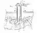 Fig. 01 - Percutaneous vertebral stabilization system