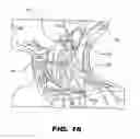 Fig. 17 - IMPLANTABLE STIMULATOR