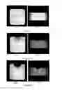 Fig. 04 - Implantable medical device