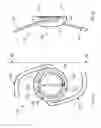 Fig. 04 - Remote multifocal to monofocal optic conversion