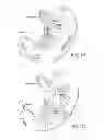 Fig. 03 - APPARATUS AND METHOD FOR TREATING OBESITY USING NEUROTOXINS IN CONJUNCTION WITH BARIATRIC PROCEDURES
