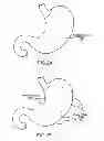 Fig. 04 - APPARATUS AND METHOD FOR TREATING OBESITY USING NEUROTOXINS IN CONJUNCTION WITH BARIATRIC PROCEDURES