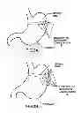 Fig. 05 - APPARATUS AND METHOD FOR TREATING OBESITY USING NEUROTOXINS IN CONJUNCTION WITH BARIATRIC PROCEDURES