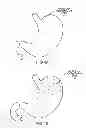 Fig. 06 - APPARATUS AND METHOD FOR TREATING OBESITY USING NEUROTOXINS IN CONJUNCTION WITH BARIATRIC PROCEDURES
