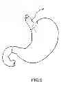 Fig. 07 - APPARATUS AND METHOD FOR TREATING OBESITY USING NEUROTOXINS IN CONJUNCTION WITH BARIATRIC PROCEDURES
