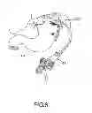 Fig. 08 - APPARATUS AND METHOD FOR TREATING OBESITY USING NEUROTOXINS IN CONJUNCTION WITH BARIATRIC PROCEDURES