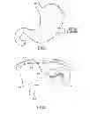Fig. 09 - APPARATUS AND METHOD FOR TREATING OBESITY USING NEUROTOXINS IN CONJUNCTION WITH BARIATRIC PROCEDURES
