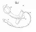 Fig. 03 - Expandable Inter Vivos Tube