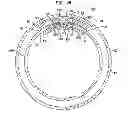 Fig. 06 - Expandable Inter Vivos Tube
