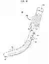 Fig. 12 - Expandable Inter Vivos Tube